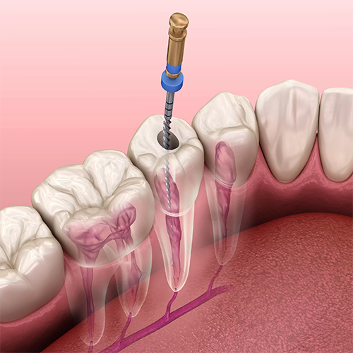 +مراقبت هاي پس از درمان ريشه :  +
