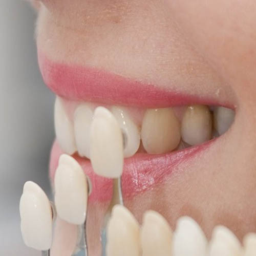 +مراقبت هاي پس از قرار دادن روكش در دهان+