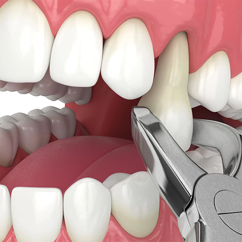 +مراقبت هاي بعد از كشيدن دندان+